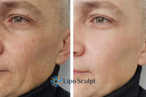 How to Fight Aging Symptoms 3 Fight Aging Symptoms Epping Green With HIFU and Morpheus8 Today!