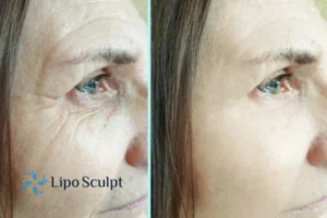 How to Fight Aging Symptoms 2 Do you want to Fight Aging Symptoms Epping Green? Contact Lipo Sculpt today!