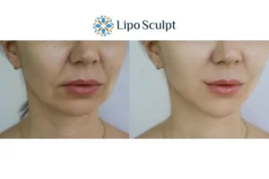 Explaining Total Skin Tightening Treatment And What It Can Do For You 2 Do you want to boost your self confidence? Give Morpheus8 Epping Green a try today!