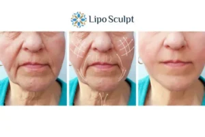 Explaining Total Skin Tightening Treatment And What It Can Do For You 3 Boost your confidence with Morpheus8 Epping Green call our team today!