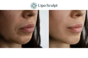 Explaining Total Skin Tightening Treatment And What It Can Do For You 4 Morpheus8 Epping Green the best results - call our team today!