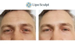 Explaining Total Skin Tightening Treatment And What It Can Do For You 6 Morpheus8 Epping Green book in today to find out more!