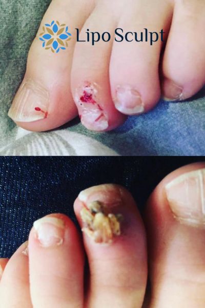 Wart removal customer results from Lipo Sculpt Epping Green