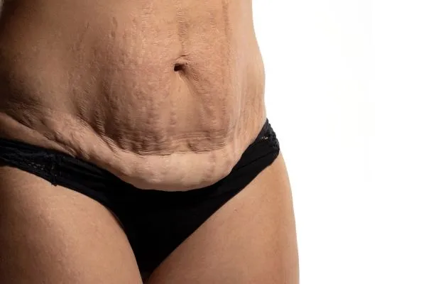 Lost the Weight but Not the Loose Skin? 1 image of womans stomach after weight loss showing loose skin Epping Green